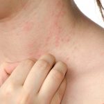 CBD for Eczema: Everything you Need to Know